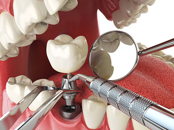 Best Root Canal Emergency Dentist  in Lynnwood Pricedale, PA
